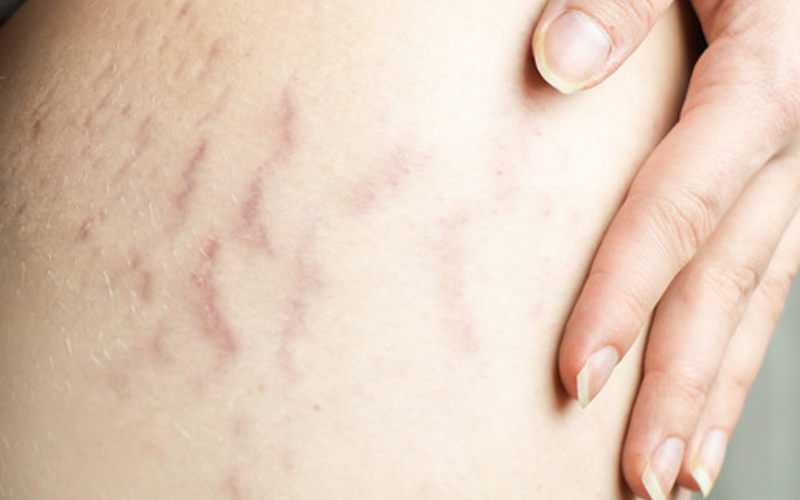 بهترین زمان انجام کربوکسی تراپی استریاهای پوستی 