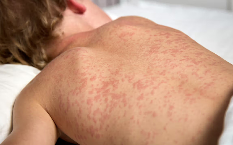 بیماری سرخجه